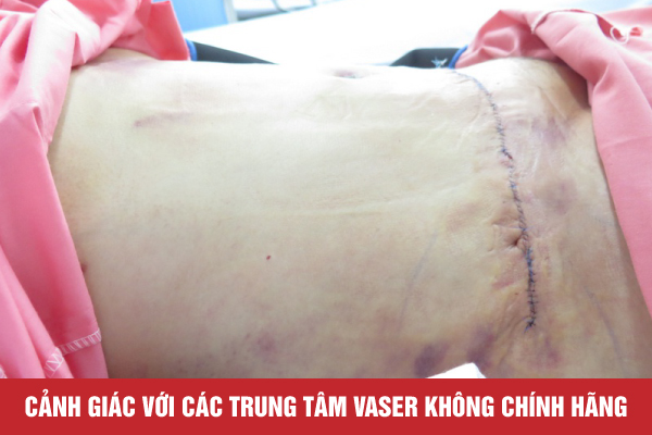 CÁC TRUNG TÂM VASER KHÔNG CHÍNH HÃNG TẠI VIỆT NAM